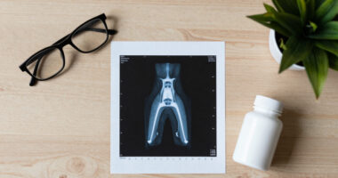 Osteopenia is silently weakening bones in millions of people